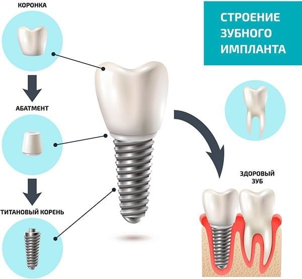 How to insert the implant tooth. Types, price, if, as is hurt, reviews
