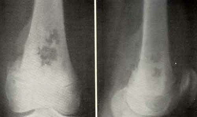 Osteosarkom: En malign tumor som påvirker beinene