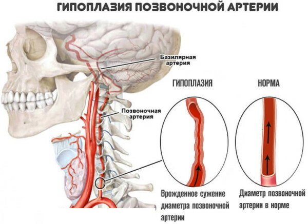 Hypoplasi i højre vertebralarterie. Hvad er det, symptomer, behandling