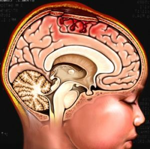 The first signs and symptoms of brain concussion in children that parents should know