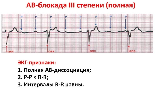 AV block 1-2-3 degrees on ECG Mobitz. What is it, the reasons, the treatment