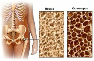 diagnostiku osteoporózy