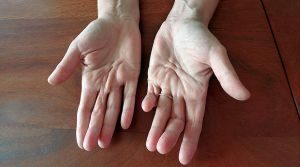 contracture of fingers