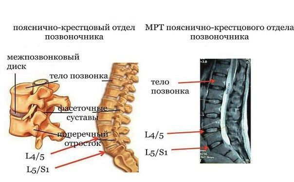 MRI of the lumbosacral spine