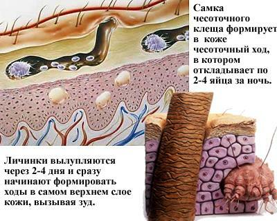 Formation of scabies