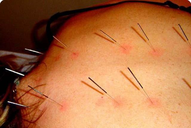 Damit die Akupunkturbehandlung funktioniert, ist es notwendig, dass der Patient diesen Eingriff freundlich und unvoreingenommen behandelt