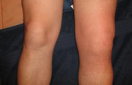 Symptome einer Synovitis des Kniegelenks