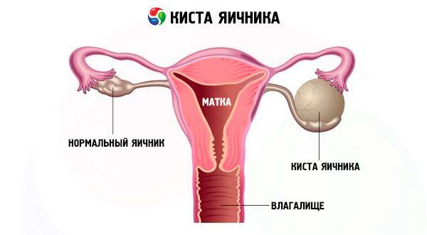 Schematic representation of the ovarian cyst