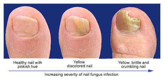 Stages of nail fungus attack