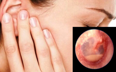 Symptoms of otitis media of the middle ear