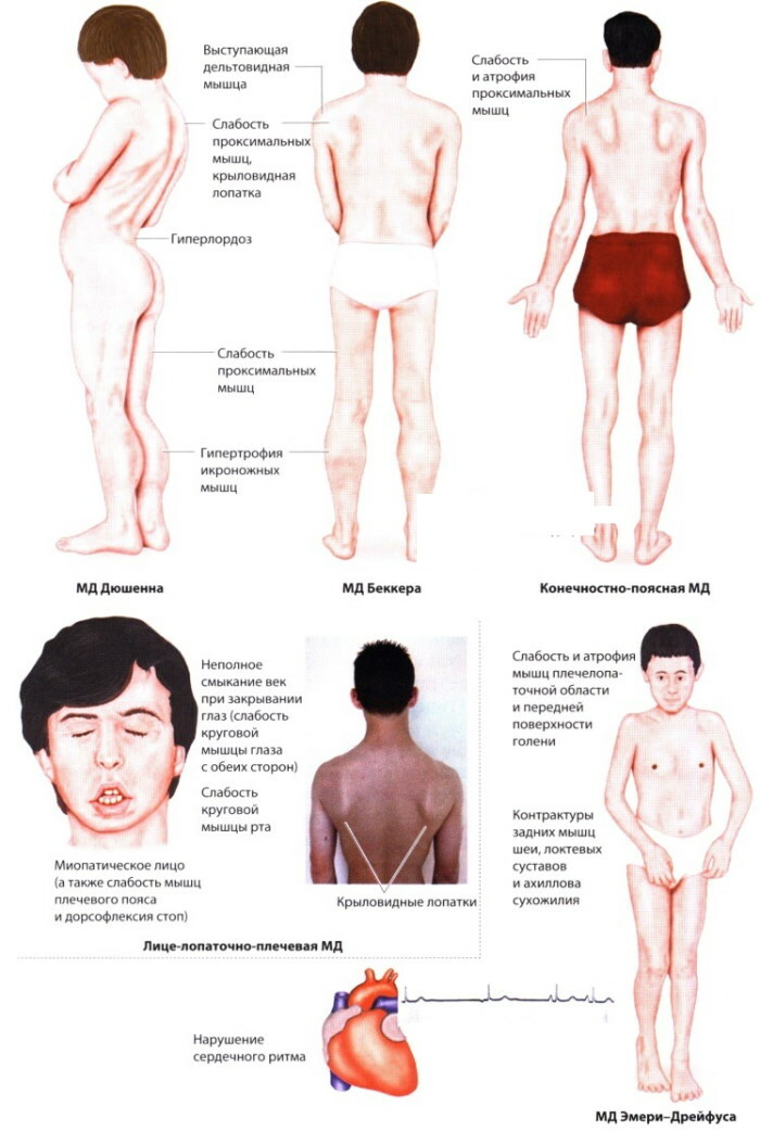 Myopathy. What is it, symptoms, causes, treatment