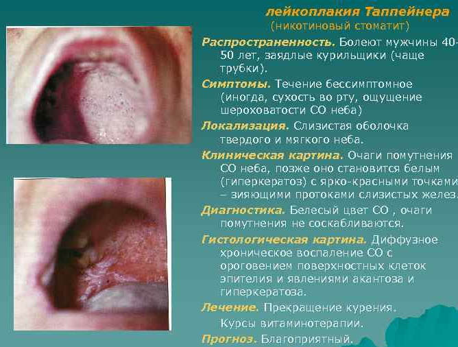 Leucoplasia da cavidade oral. Foto, diagnóstico diferencial