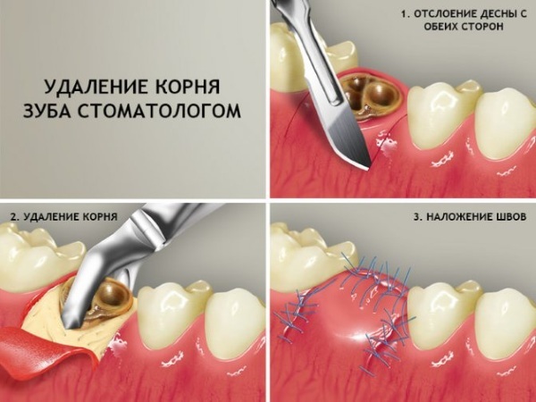 Removal of a molar tooth. Price, does it hurt, how long does it hurt, how do they do with a child, a teenager