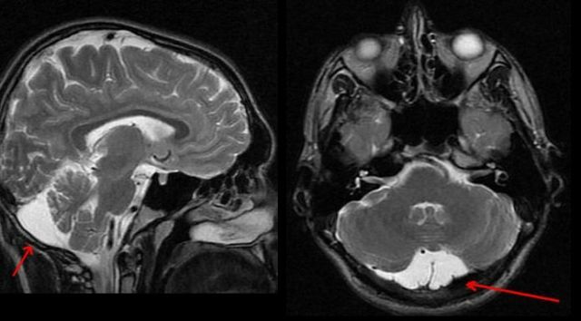 Likvornaya-cyste van de hersenen - wat is het, de vormen, de behandeling en de gevolgen