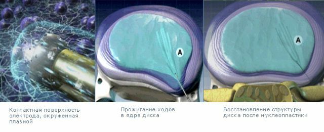 Cold-plasma nucleoplasty is an innovation in the treatment of hernia of the spine