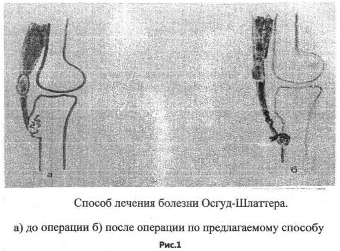 Osgood-Schlatter disease. X-ray, stages, description, treatment