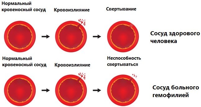 Coagulabilitatea sângelui: norma la femeile dintr-o venă, degetul după vârstă
