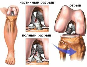De oorzaken en methoden van therapie van instabiliteit van het kniegewricht