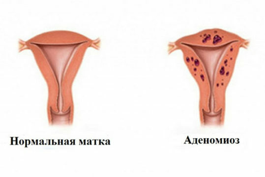 Graviditet i adenomyose i livmoderen