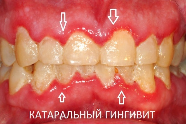 Gingivitis. Treatment in adults, children, drugs, folk remedies, causes