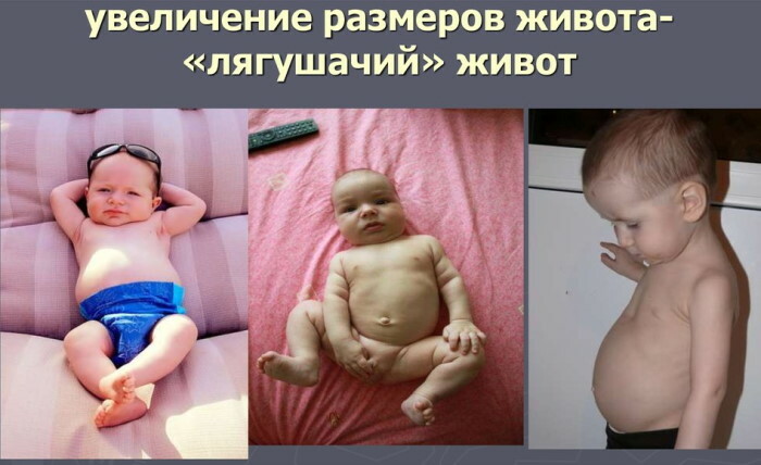 Frog belly in a child, newborn. Exercises how to clean