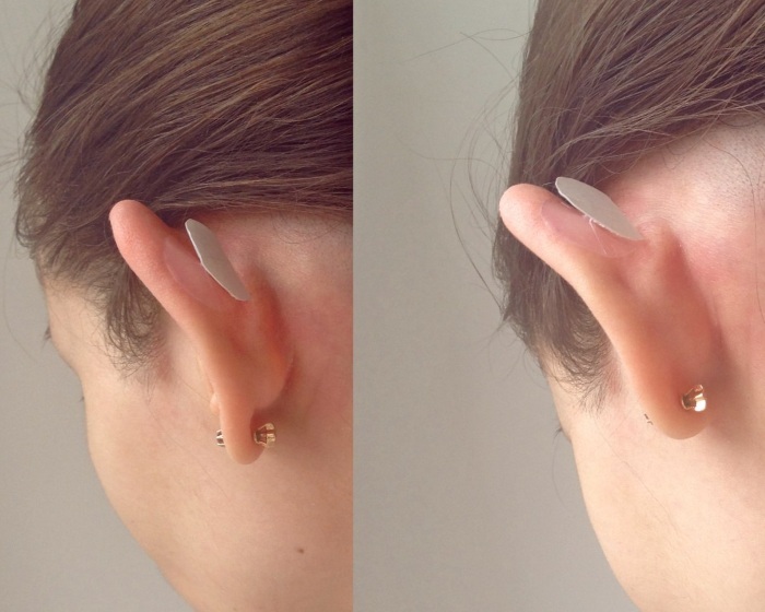 Corretor de ouvido Arilis. Compre, peça para recém-nascidos, adultos