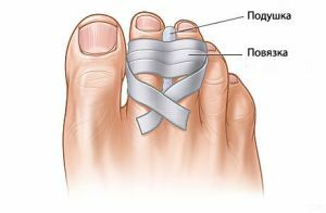 At the first symptoms of a broken toe, immediate treatment is necessary