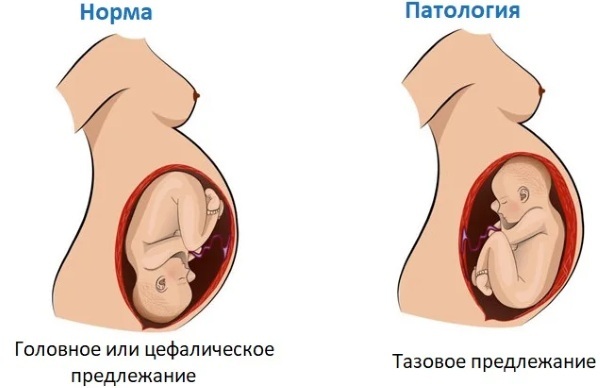 Apresentação cefálica do feto em 20-30 semanas de gestação