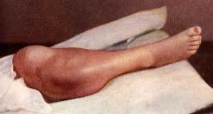 Osteosarcomul genunchiului