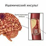 ishemična možganska kap