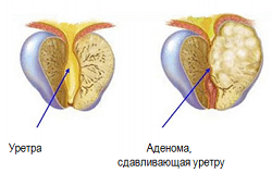 Prostat adenomu