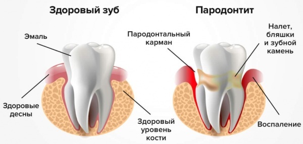 Periodontitis. Home treatment with folk remedies, decoctions, ointments, antibiotics. Etiology, pathogenesis, causes