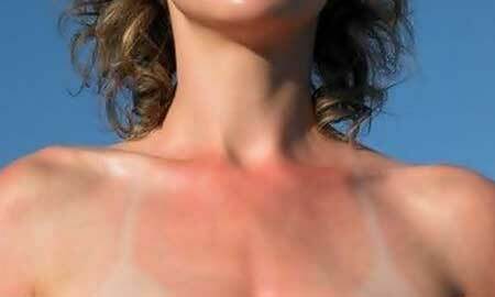 What should I do if I get sunburned? Treatment of sunburn