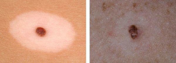 Tratamento de vitiligo: medicamentos, vitaminas, pomadas, lâmpada UV, laser. Avaliações