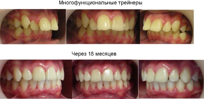 The girl has crooked teeth. Before and after photos, how to fix, align in children, adolescents, which doctor, methods with and without braces