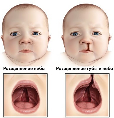 La boca de lobo en los niños. Fotos antes y después de la cirugía, causas de aparición, tratamiento.