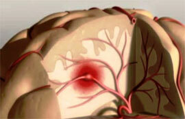 Ruptur av cerebrale aneurysmer