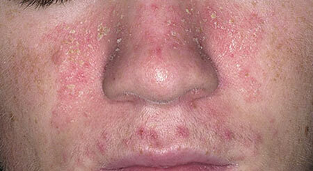 Seborrheic dermatitis: okai és kezelése, fotó az arcon és a fejön