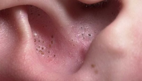 Como remover acne nos ouvidos: como espremer, pomadas, remédios populares