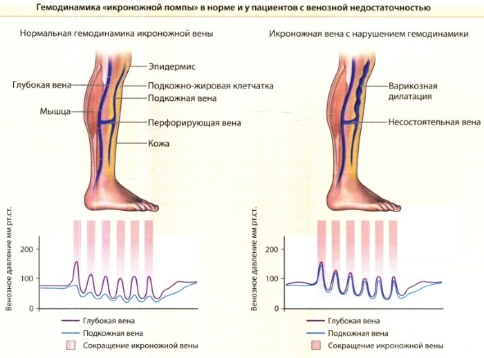 Chronic venous insufficiency. Classification, treatment, degrees, stages in adults