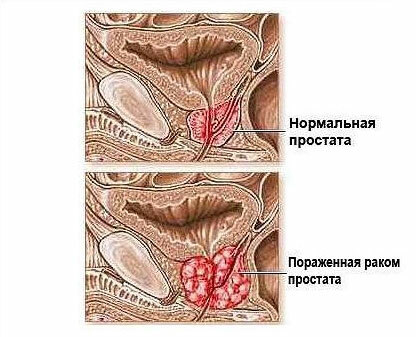 A tumorok a férfiakban