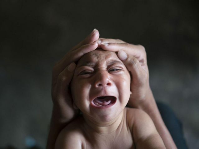 Microcefalia fotos de uma criança
