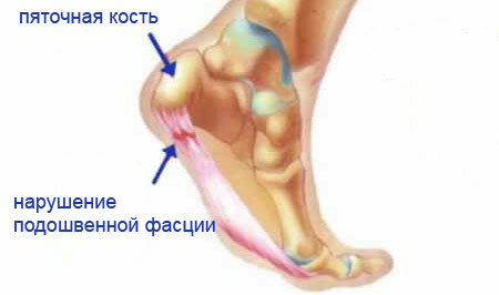 Causes of pain in the heel