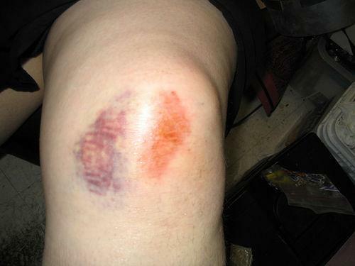 Dislocazione del ginocchio: foto, sintomi