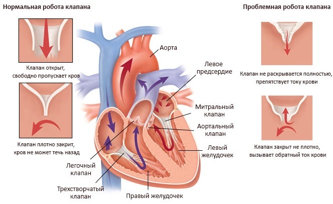 Damage to heart valves. What leads to disease, arrhythmia, myocardial infarction, angina pectoris