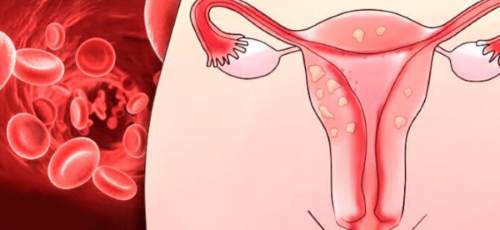 Como parar o sangramento do útero sem um hospital para miomas, menstruação, endometriose, aborto