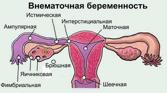 Types de grossesse extra-utérine