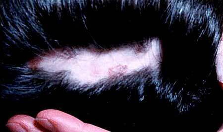 Androgén alopecia a nőknél