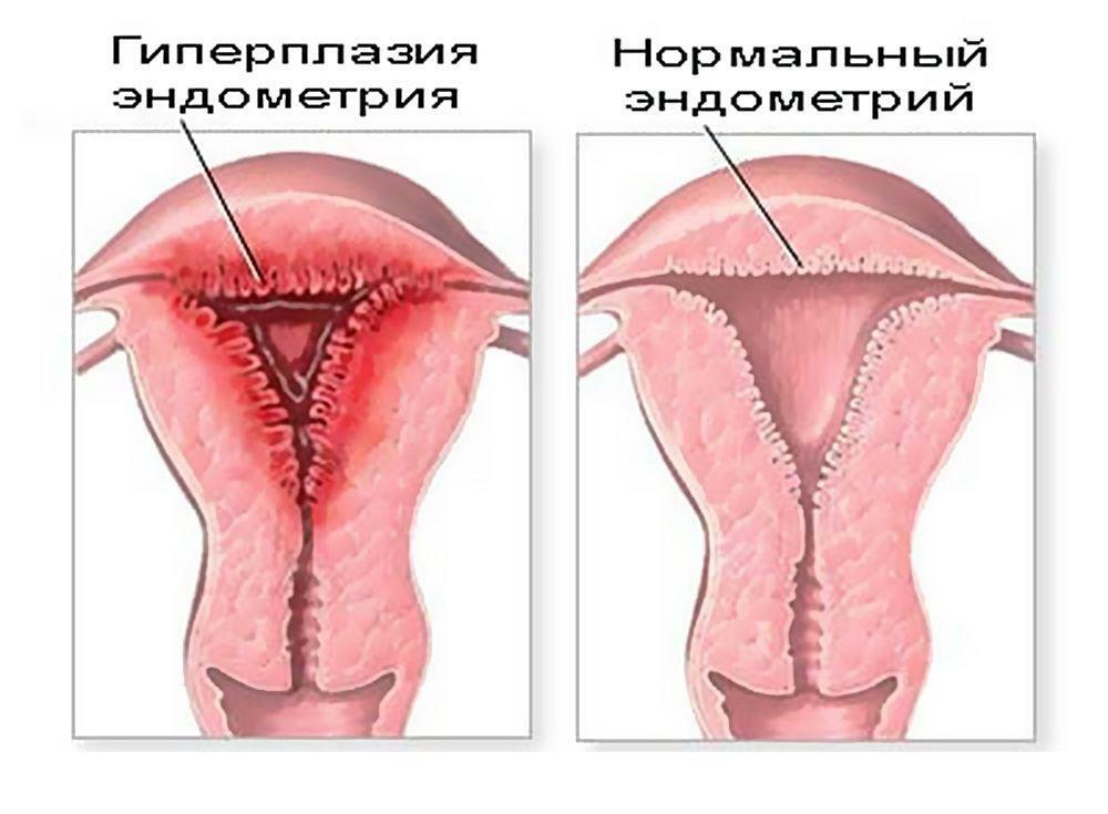 Hyperplasia and normal endometrium