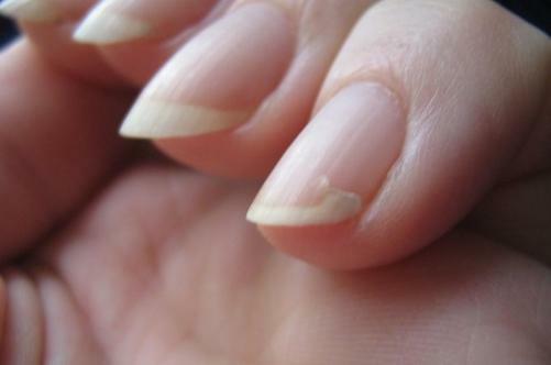 Layered nails and hair falling out - signs of psychosomatics of hair loss Lapped nails and hair falling out - signs of psychosomatics of hair loss